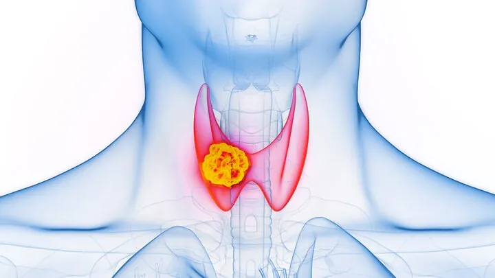 آیا درمان سرطان تیروئید با بررسی DNA افراد ممکن است؟